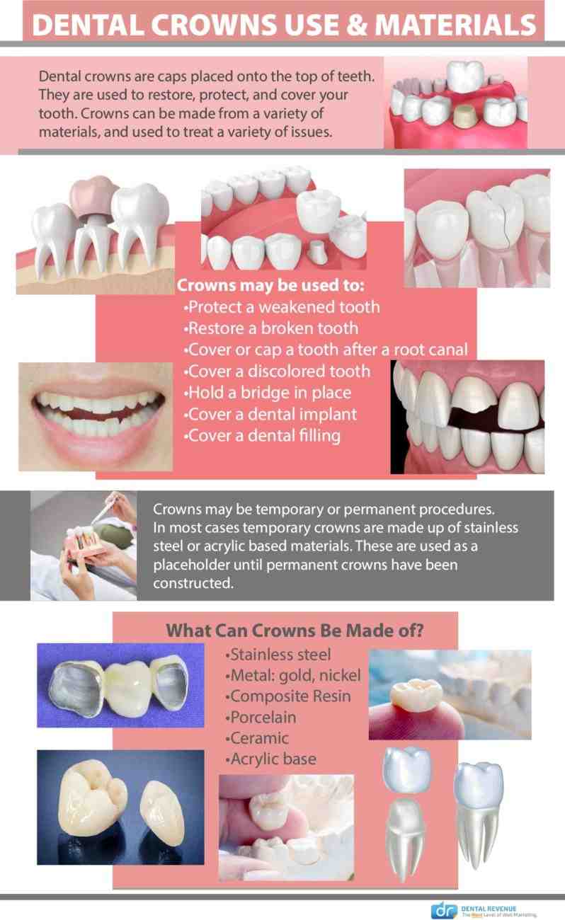 Which is the best material for dental implant crowns Dental News Network