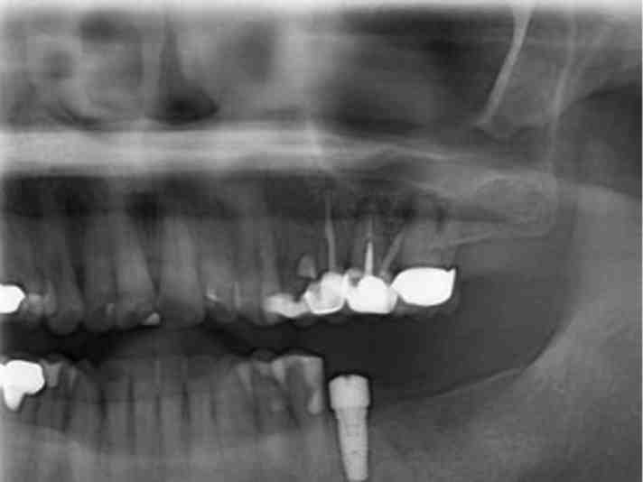 What is the code for dental implants?