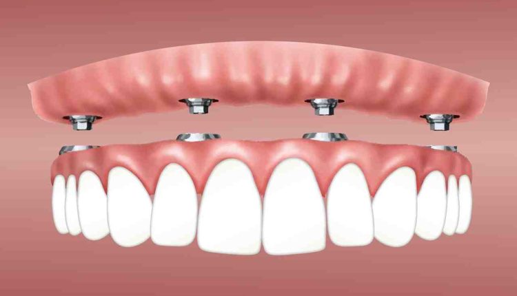 What is the cost of dental implants per tooth