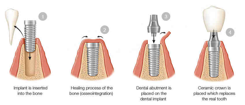 What is the first step of a dental implant?