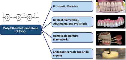 What is the life expectancy of dental implants?