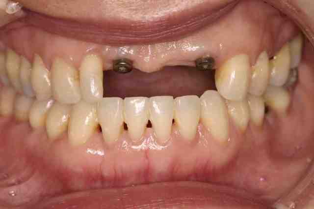 What is the most affordable way to get dental implants?