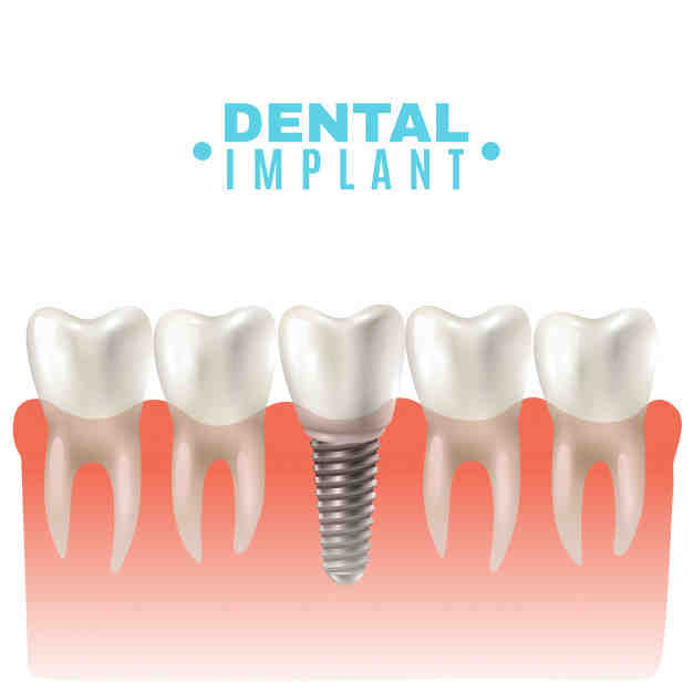 What is the next step after dental implant?