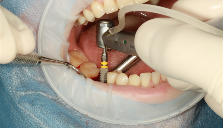 What is the process for a dental implant