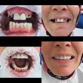 What is the safest tooth implant material?