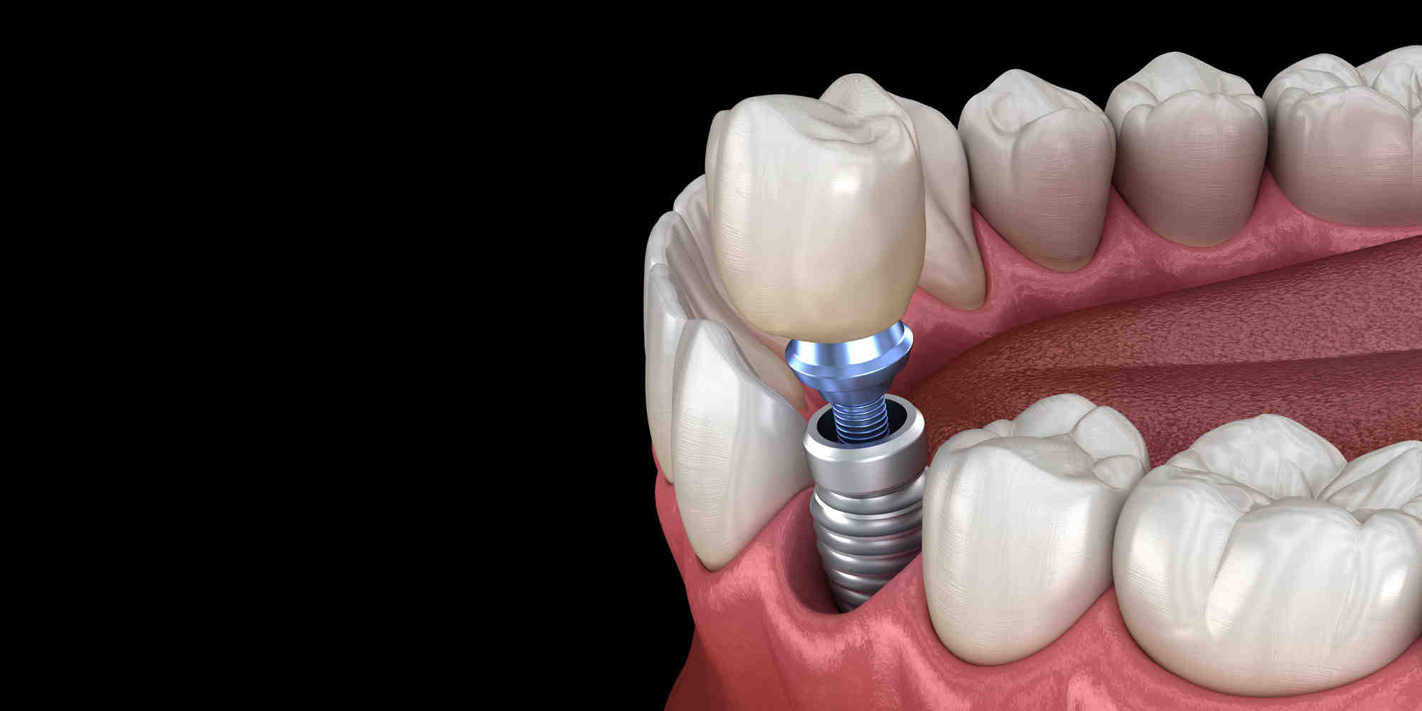 What is the technical name for dental implants?