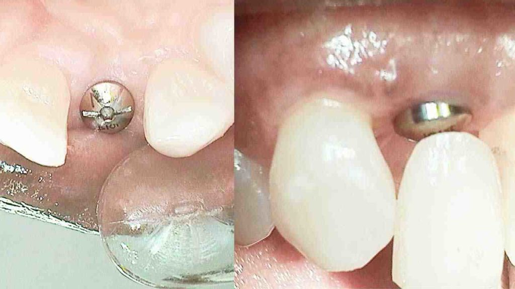 Which is the best material for dental implant crowns Dental News Network