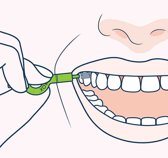 What should not be used to clean around a dental implant?