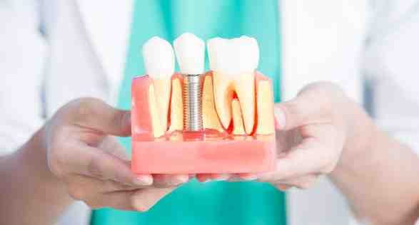 What should you not do before dental implants?
