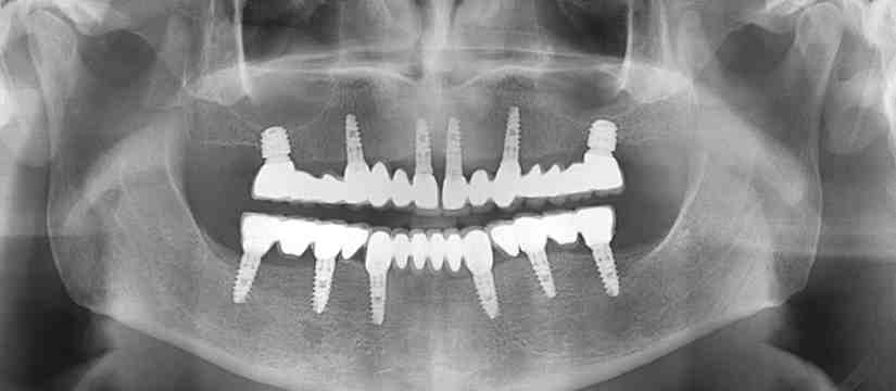 What type of X rays are needed for implant placement?