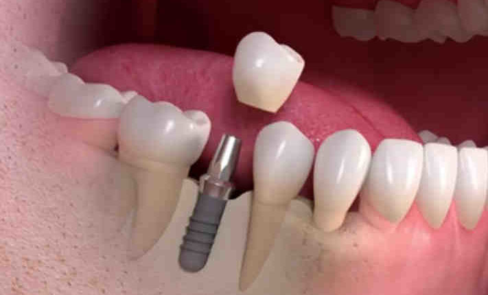 What year did the dental implants come out