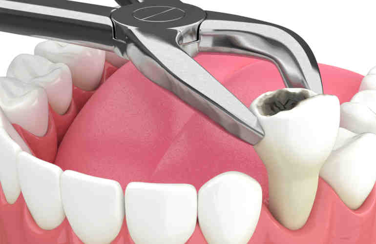 When is the best time to get dental implants?