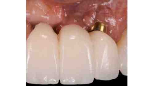 Where do dentists get bone for bone grafts?
