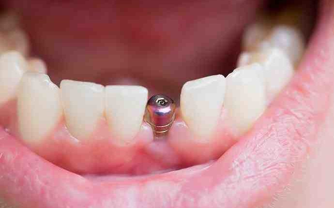 Where does the bone graft come from for dental implants
