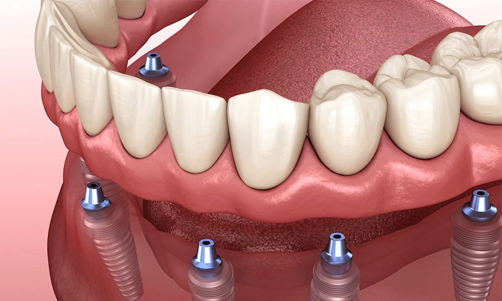 Where is the most inexpensive place to get dental implants?