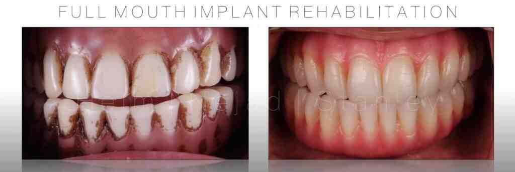 Which is better zirconia or porcelain crown?