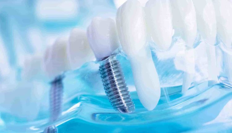 Who in houston texas has the cheapest price on dental implants
