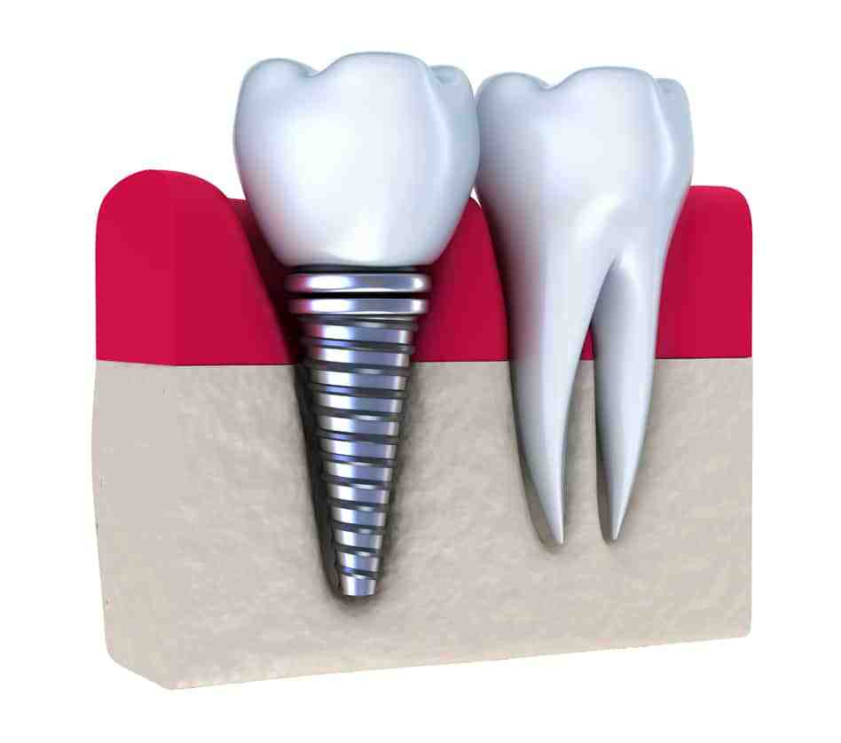 Who should not get dental implants?