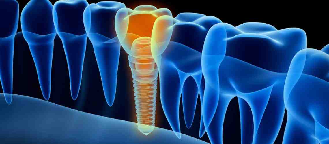 Who usually needs dental implants?