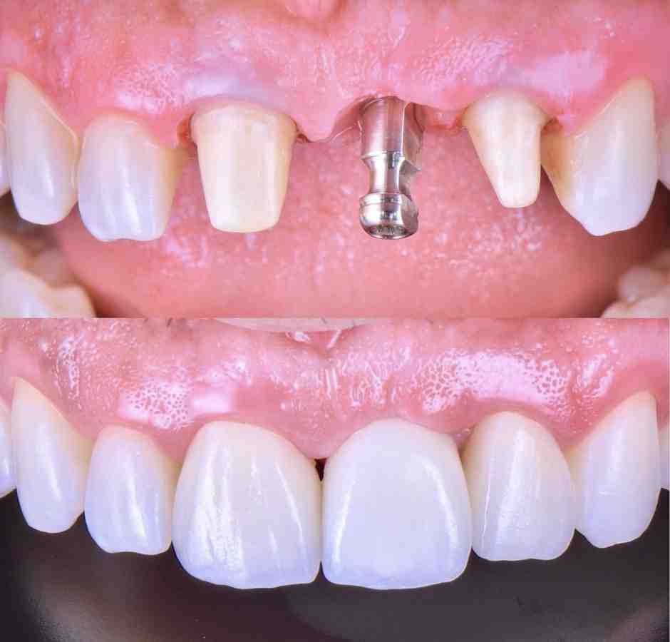 Why are dental implants significant for patients?