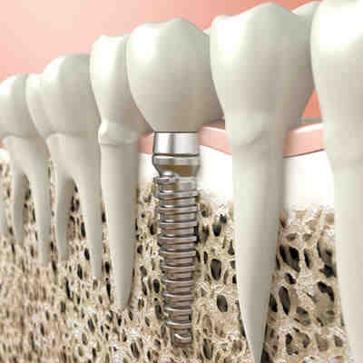 Why can't smokers get dental implants?