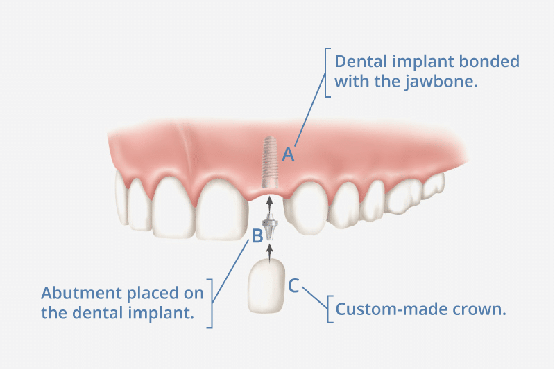 Why dental implants are bad?