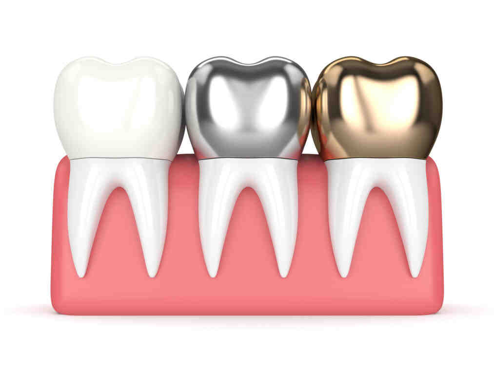 Why do I need a crown on an implant?