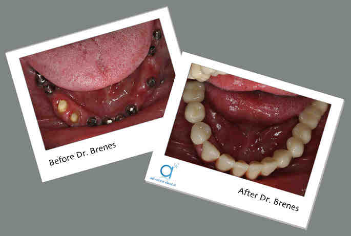 Why you should never get a dental implant?