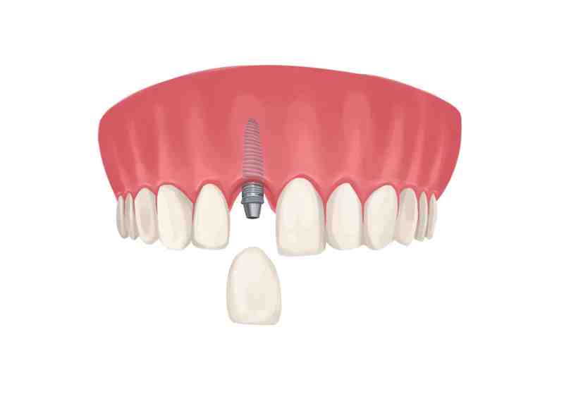 What insurance should i get if im planning to get dental implants