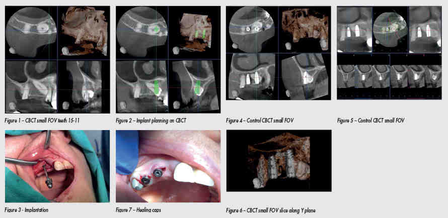 Do bone grafts hurt as they heal?