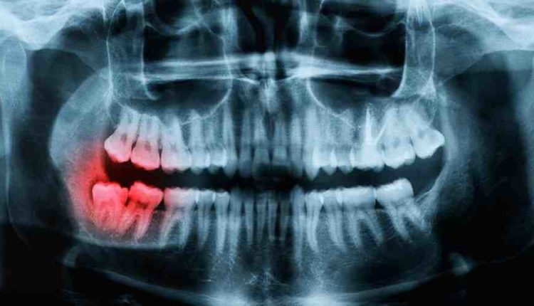 is-small-amount-of-swelling-after-dental-implants-dental-news-network