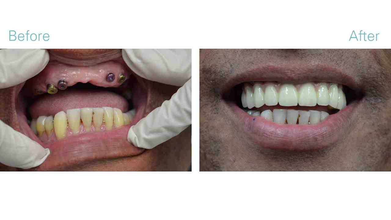 Are 6 implants better than 4?