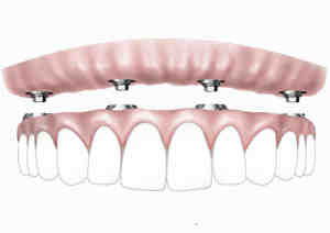 Are All-on-4 implants worth it?