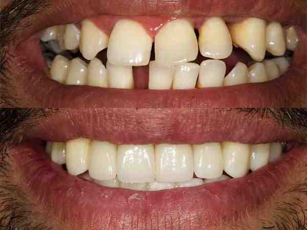 Are Mini dental implants FDA approved?
