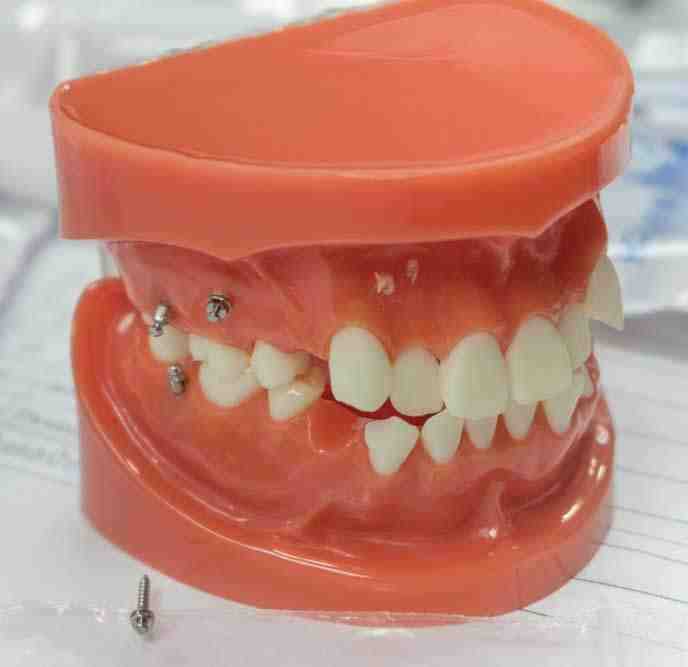 Are Mini dental implants FDA approved?