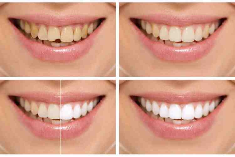 Are Snap on dentures any good?