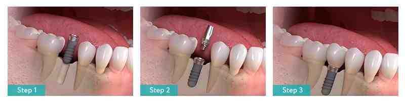 Are bisphosphonates a contraindication for implants?