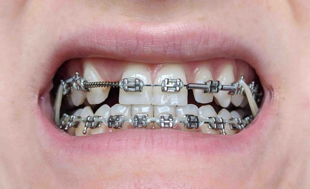 Are braces possible after dental implants Dental News Network