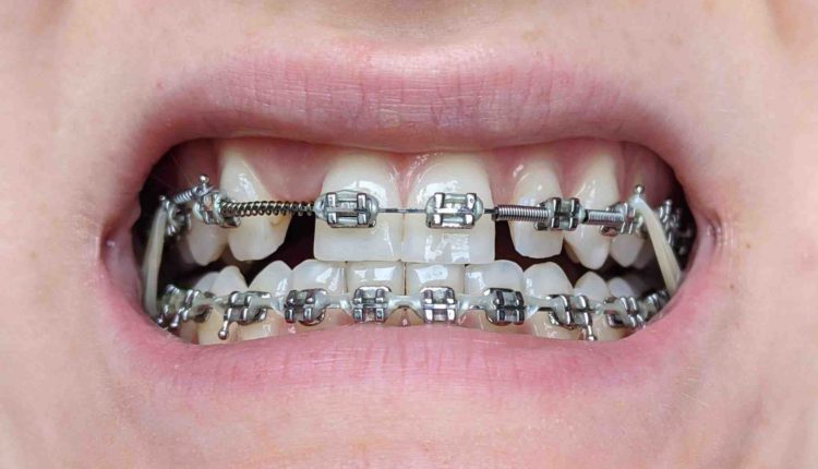 Are braces possible after dental implants