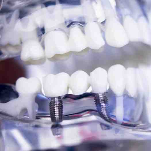 Are bridges more comfortable than dentures?
