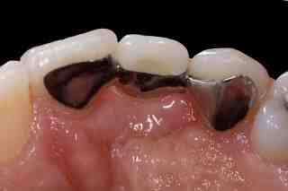 Are bridges safer than implants?