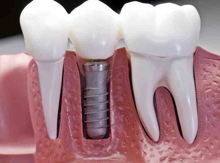 Are dental crowns considered cosmetic?