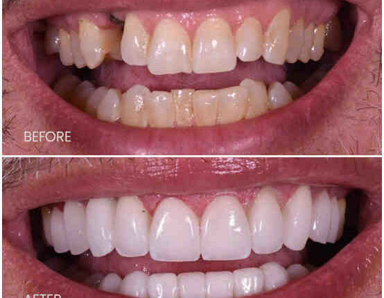 Are dental implant safe?