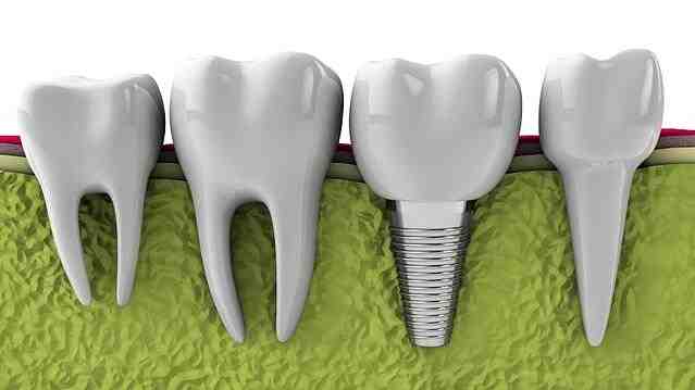 Are dental implants Worth the Risk?
