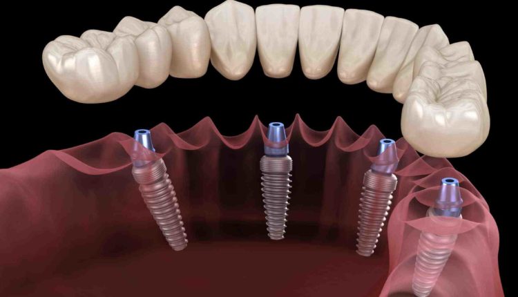 Are dental implants a good choice