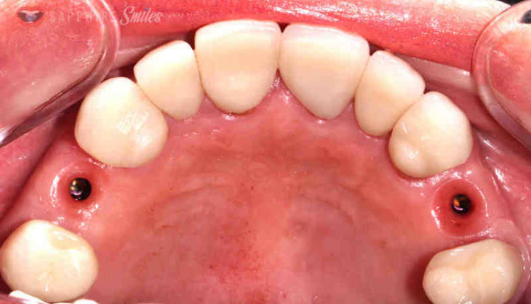 Are dental implants as strong as real teeth?