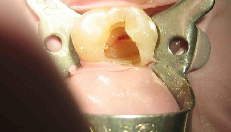 Are dental implants cheaper than root canals