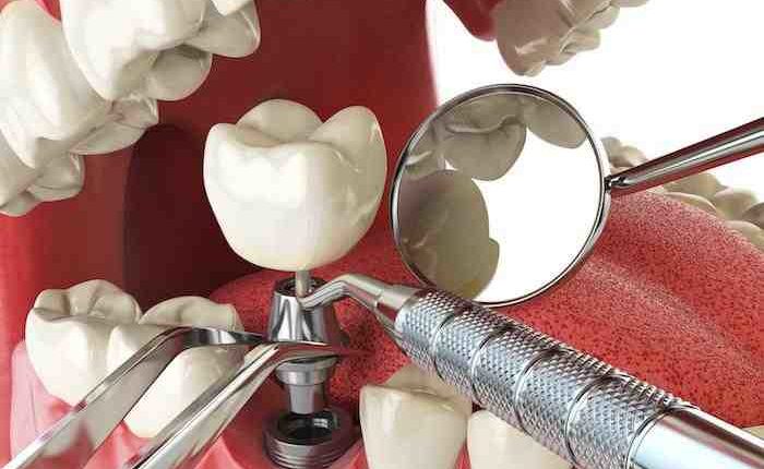 Are dental implants good for you