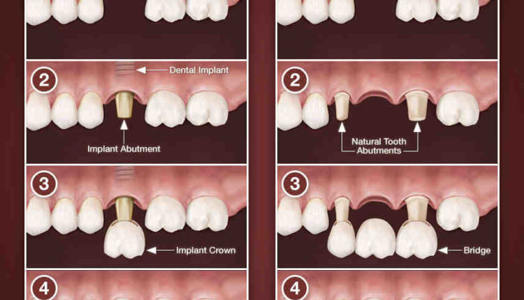 Are dental implants more expensive than bridges ?