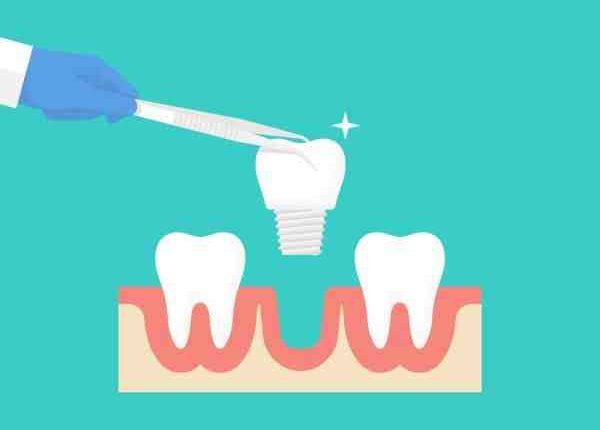Are dental implants necessary